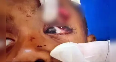Imagem ilustrativa da notícia: Menino de 6 anos perde visão após ser atingido por estilhaços de fuzil no RJ