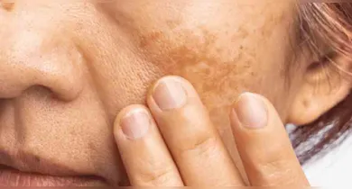 Imagem ilustrativa da notícia: Melasma: confira os cuidados essenciais para controlar as manchas