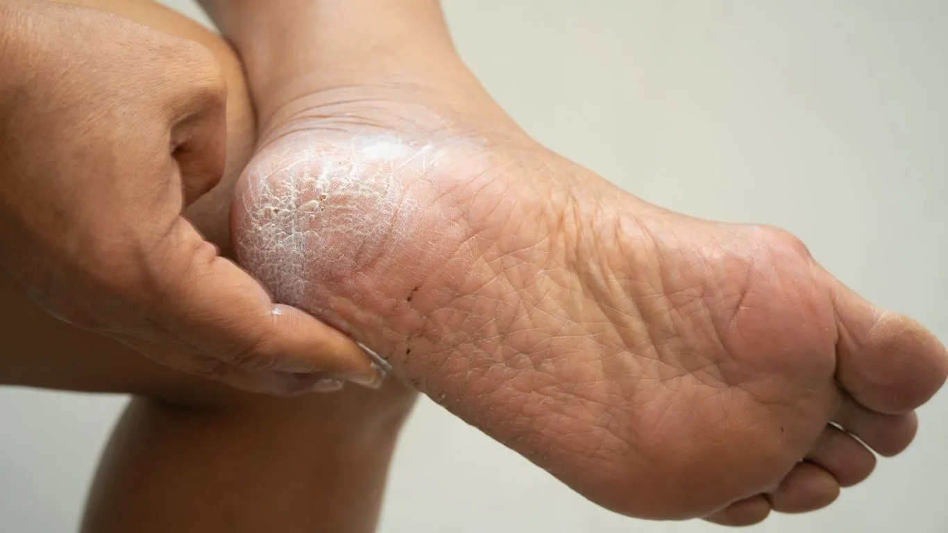 Imagem ilustrativa da notícia: Além da estética: saiba por que os pés racham e como tratar