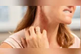 Brotoeja pode aparecer em períodos de calor intenso devido ao excesso de suor e à permanência da pele úmida.