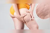 A lipoaspiração de pernas tem sido utilizada como parte do manejo clínico do lipedema
