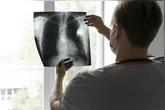 Para receber o tratamento, é necessário apresentar alta expressão da proteína c-Met nas células tumorais.