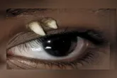 Adolescente na Índia desenvolveu um dente ectópico na órbita ocular; tomografia identificou um canino, posteriormente removido por cirurgia.