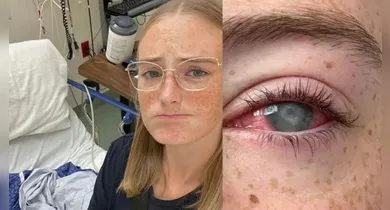 Imagem ilustrativa da notícia: Jovem perde a visão após tomar banho usando lentes de contato