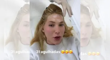 Imagem ilustrativa da notícia: Virginia faz 31 aplicações de botox contra enxaqueca