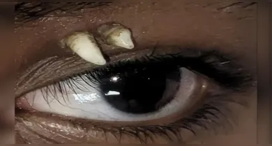 Imagem ilustrativa da notícia: Dente cresce acima do olho de adolescente e assusta médicos