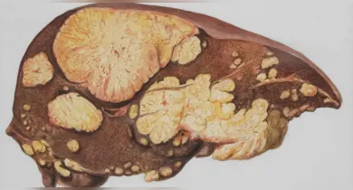 Imagem ilustrativa da notícia: Gordura no fígado: 5 sintomas que podem surgir no estágio inicial