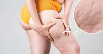 A lipoaspiração de pernas tem sido utilizada como parte do manejo clínico do lipedema