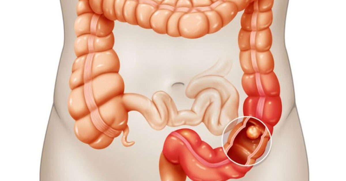 Oncologista alerta sobre sintomas do Câncer Colorretal