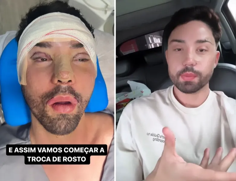 Marcello Antony é chamado de 'Ken Humano' após harmonização