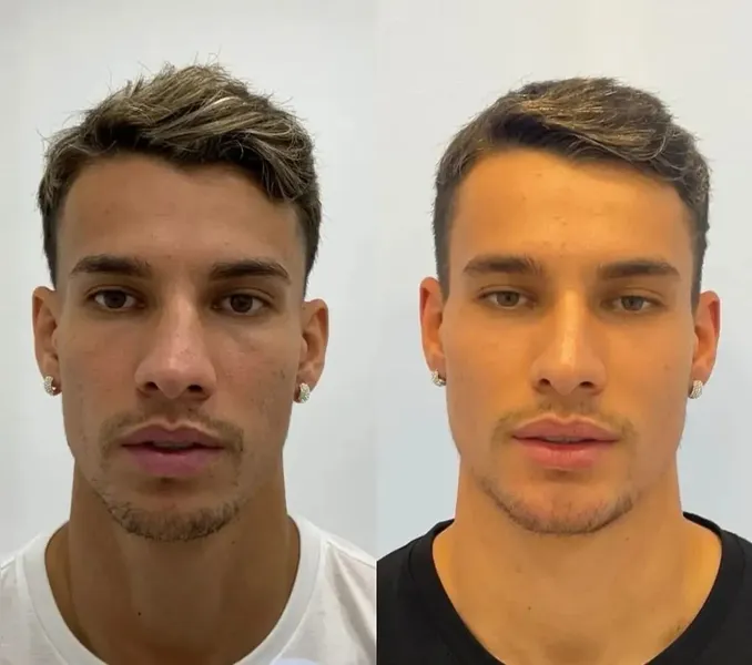 Goleiro do Remo já fez harmonização facial; veja outros jogadores que mudaram a aparência