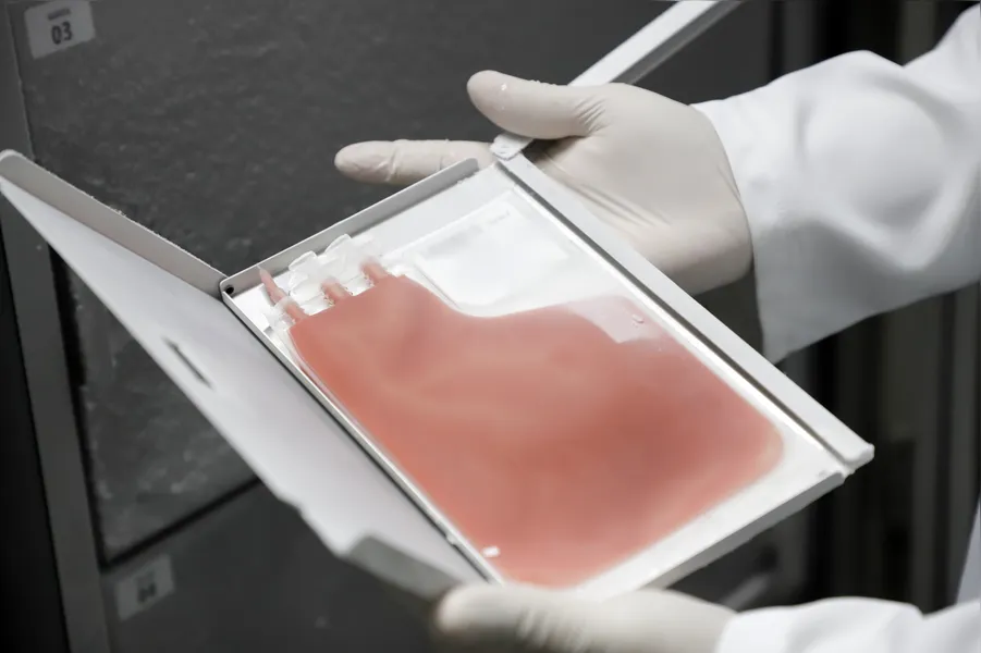 HSM realiza centésimo transplante de medula óssea da Região Norte