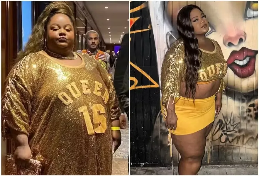 MC Carol gasta R$ 100 mil em cirurgias plásticas. Veja resultado!