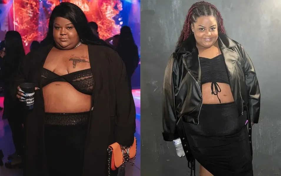 MC Carol gasta R$ 100 mil em cirurgias plásticas. Veja resultado!