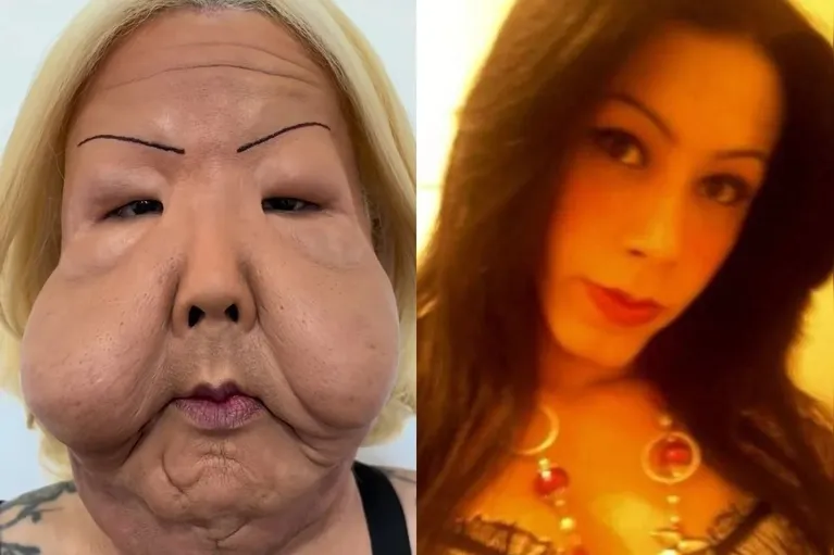 Juju do Pix faz nova cirurgia para retirar óleo mineral do rosto