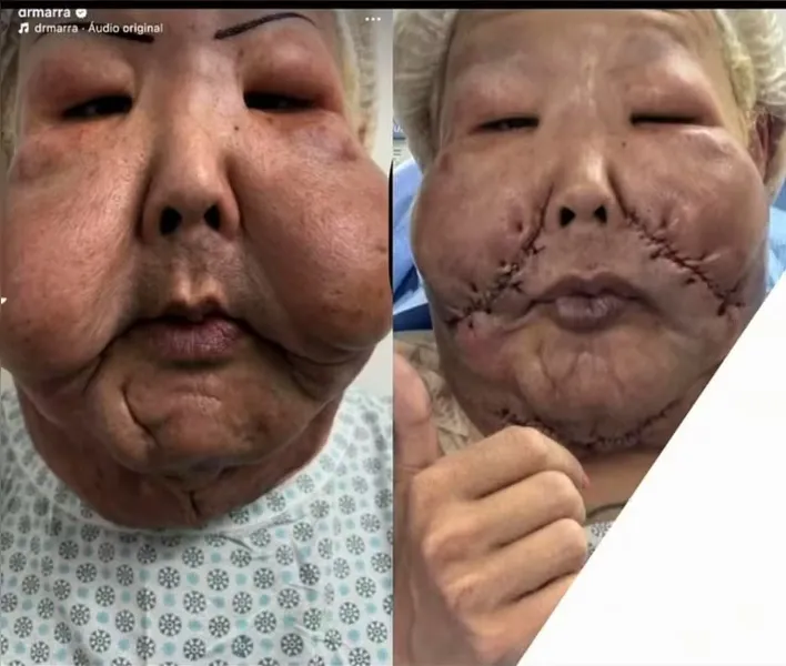 Médico mostra rosto de Juju do Pix após retirar óleo mineral