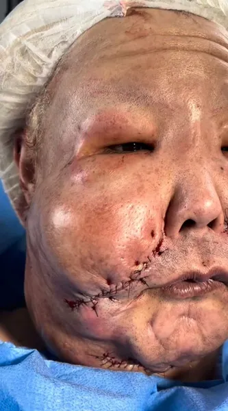 Médico mostra rosto de Juju do Pix após retirar óleo mineral