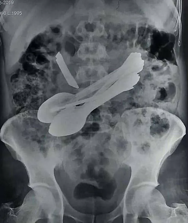 Exame de RX do paciente.