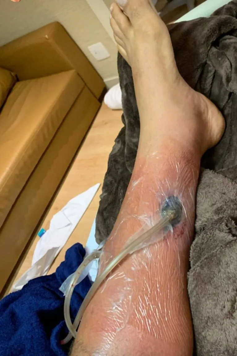 Assustador! Junior Cigano mostra buraco gigante na perna causado por bactéria