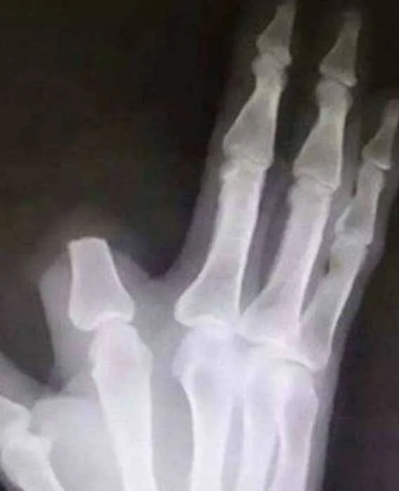 Radiografia mostra como ficou a mão do paciente. 