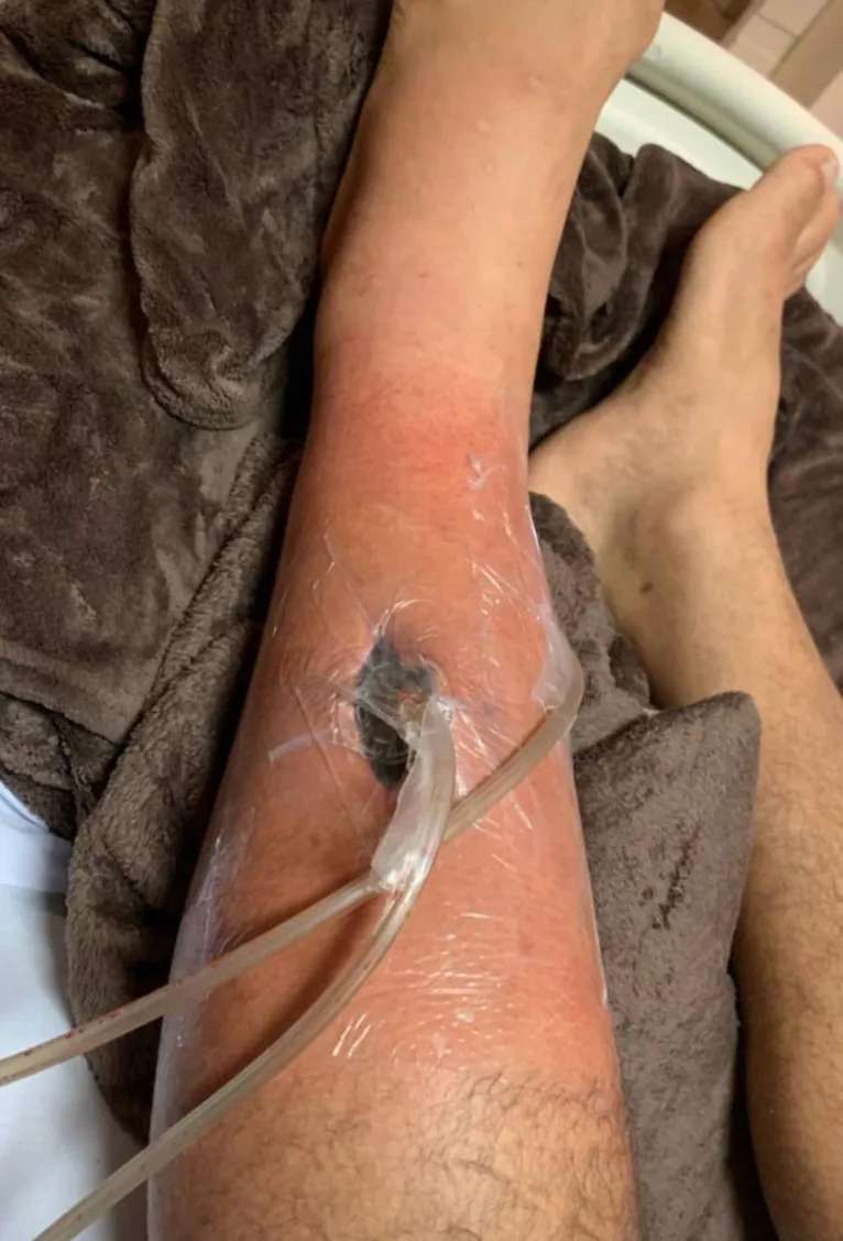 Assustador! Junior Cigano mostra buraco gigante na perna causado por bactéria