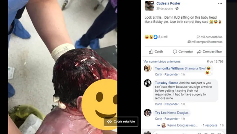 Segundo a mãe, os médicos tiveram que lavar o cabelo do bebê com muito cuidado para remover o DIU
