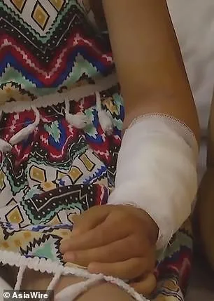O braço da menina após ter ficado preso na escada rolante