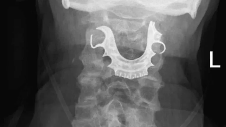 Exame de raio-x mostrando a dentadura.