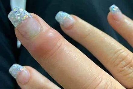 Mulher quase perde o dedo após contrair infecção em manicure