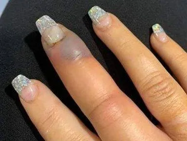 Mulher quase perde o dedo por infecção após manicure
