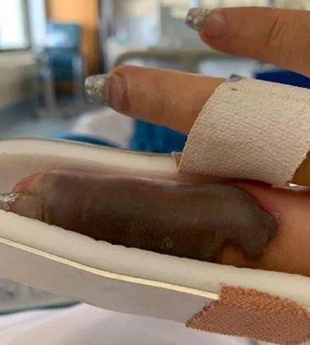 Mulher quase perde o dedo por infecção após manicure