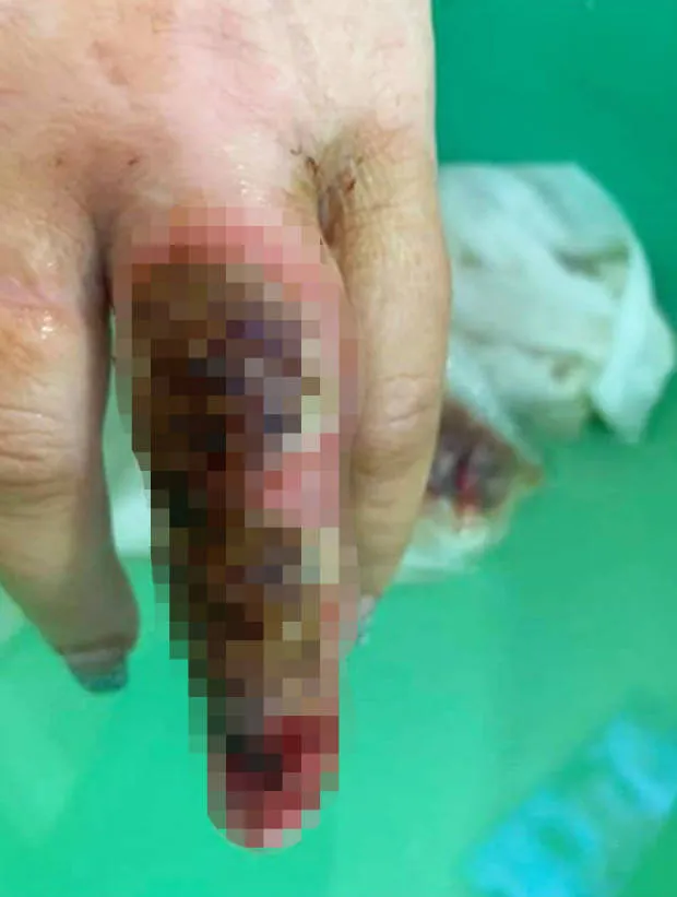 Mulher quase perde o dedo por infecção após manicure
