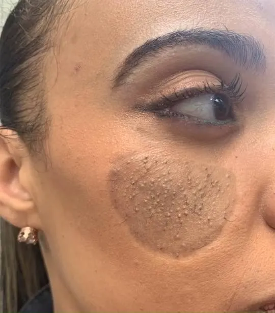 Pelos pubianos crescem no rosto de mulher após enxerto