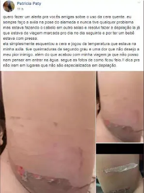 Mulher tem queimaduras graves na axila após depilação com cera