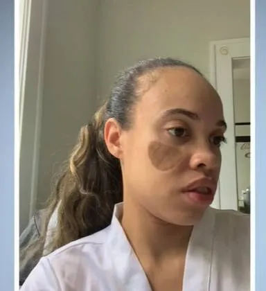Pelos pubianos crescem no rosto de mulher após enxerto