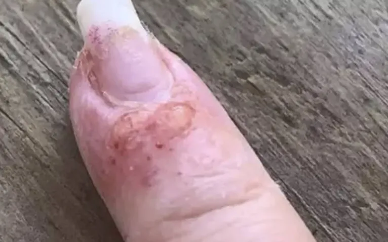 A jovem está recebendo o tratamento médico adequado após a contaminação.