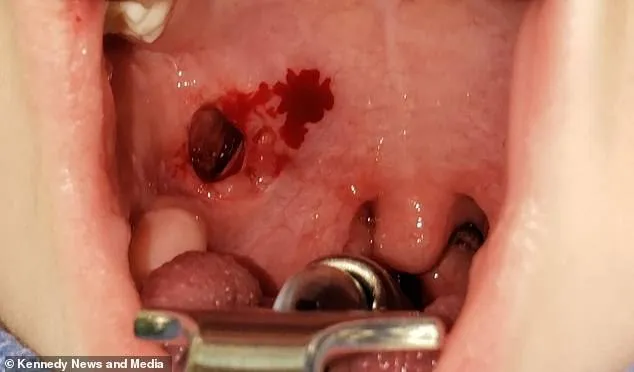 A menina ficou com um buraco na garganta por causa da escova de dente.