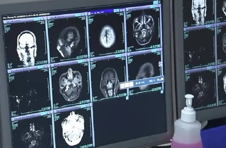 A equipe médica detectou cerca de 700 ovos de tênia no cérebro do homem.