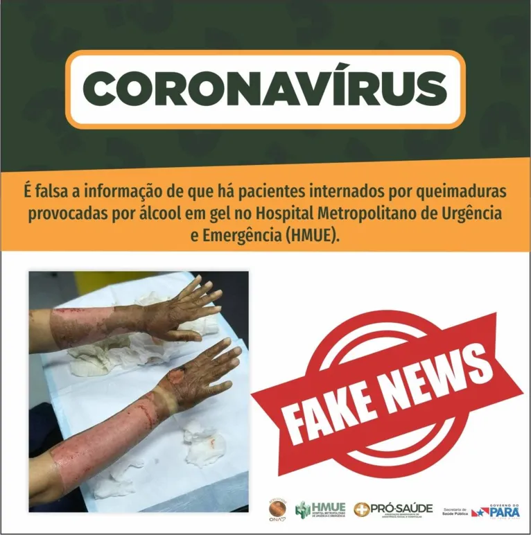 Alerta! Imagem de mulher que sofreu queimaduras por uso de álcool em gel é falsa