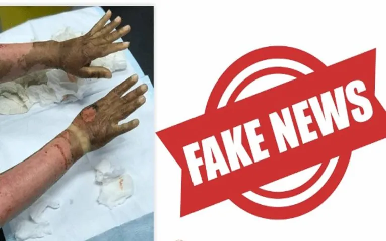 Alerta! Imagem de mulher que sofreu queimaduras por uso de álcool em gel é falsa