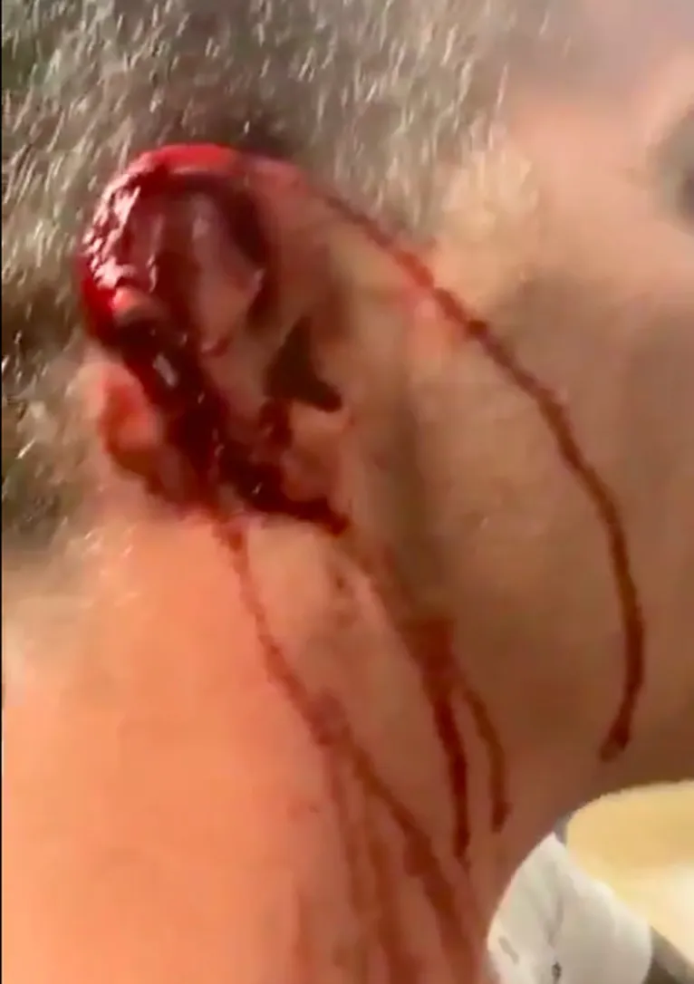 A orelha de Steve-O ficou completamente destruída 