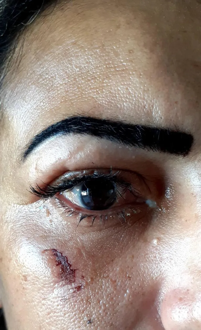 Mulher sofre lesões graves nos olhos após colocar cílios postiços, veja 