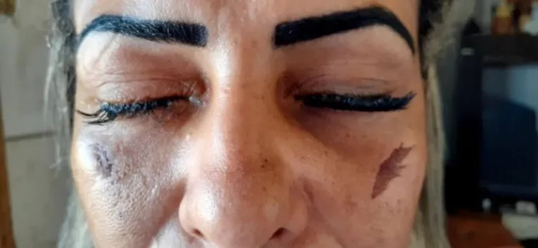 Mulher sofre lesões graves nos olhos após colocar cílios postiços, veja 