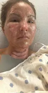 Mulher acaba com corpo queimado após usar álcool em gel nas mãos