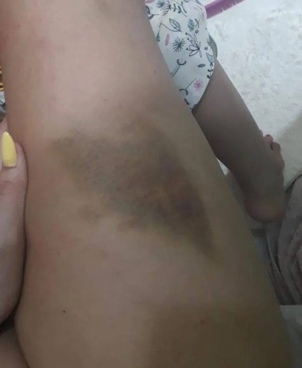 Paraense denuncia agressão de namorado e abusos psicológicos 