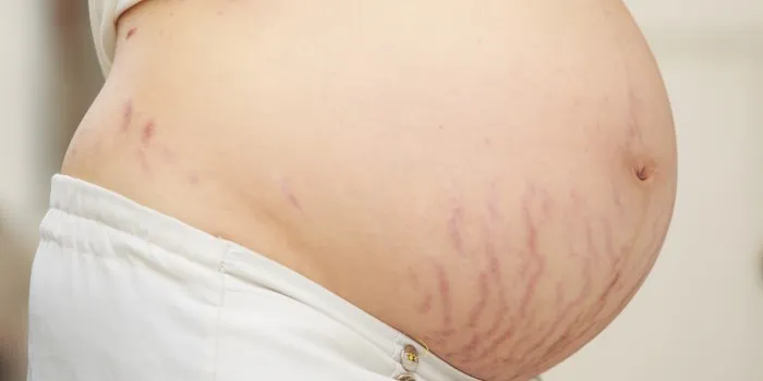 'Coçar' a barriga na gravidez pode causar estrias? Veja como evitá-las!