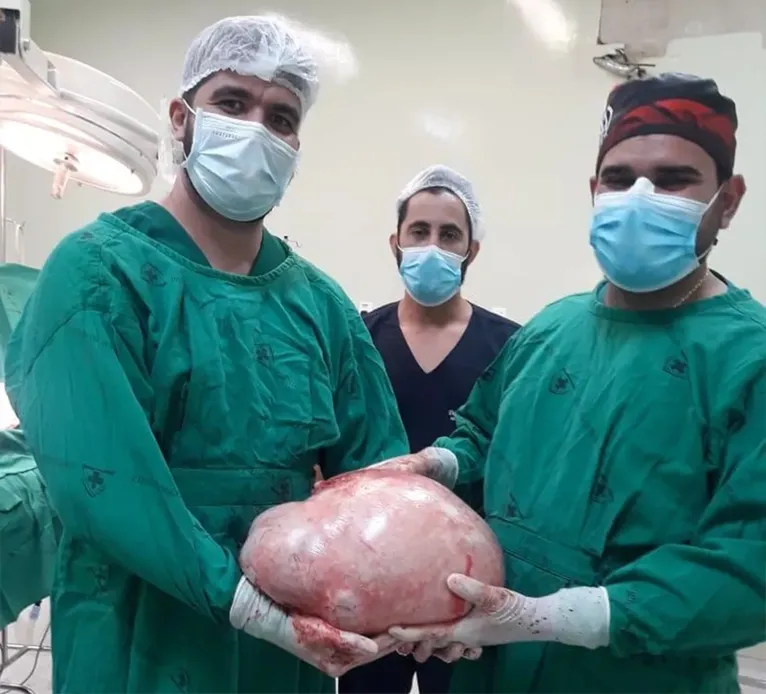 Médicos retiram tumor gigante de 20 kg de jovem. Imagens fortes!