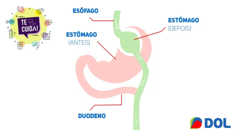 Cirurgia bariátrica: questão estética ou de saúde?
