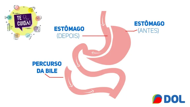 Cirurgia bariátrica: questão estética ou de saúde?