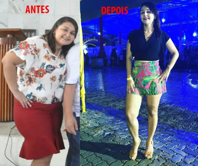 Cirurgia bariátrica: questão estética ou de saúde?